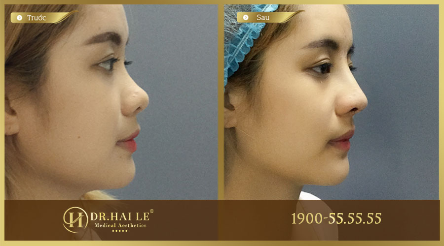 Hình ảnh khách hàng trước và sau khi nâng mũi tại Dr.Hải Lê
